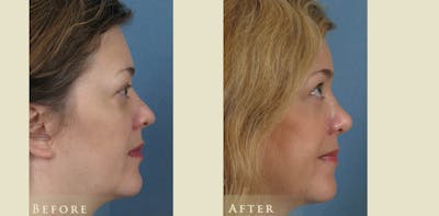 Aesthetic Rhinoplasty Before & After Gallery - Patient 272400 - Image 3