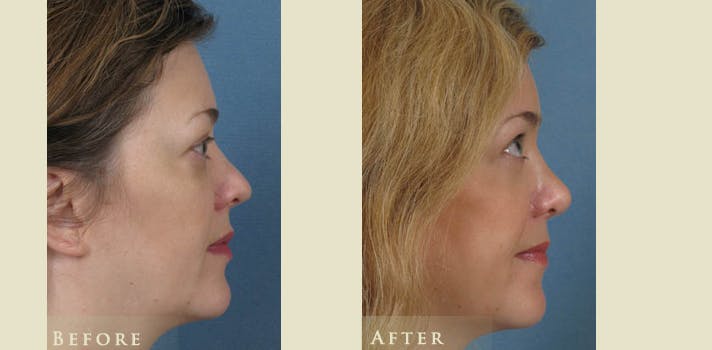 Aesthetic Rhinoplasty Before & After Gallery - Patient 272400 - Image 3