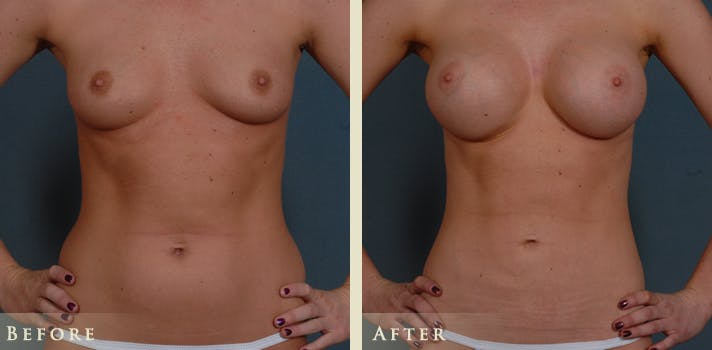 Mommy Makeover Before & After Gallery - Patient 135394 - Image 1