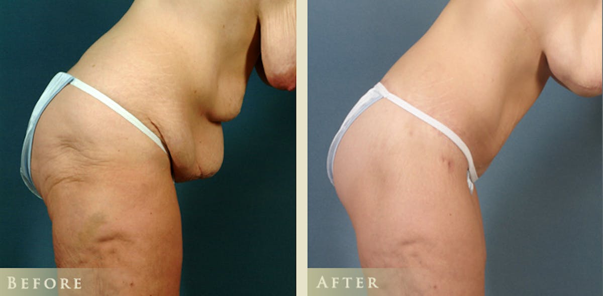 Body Lift Before & After Gallery - Patient 345715 - Image 4