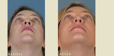 Aesthetic Rhinoplasty Before & After Gallery - Patient 272400 - Image 4