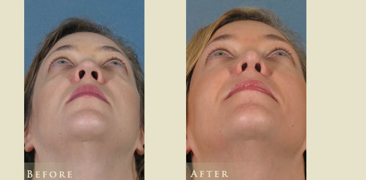 Aesthetic Rhinoplasty Before & After Gallery - Patient 272400 - Image 4