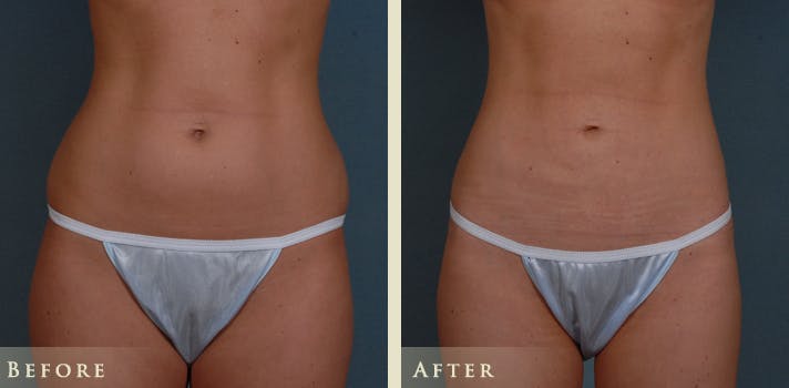 Female Liposuction Before & After Gallery - Patient 282328 - Image 1