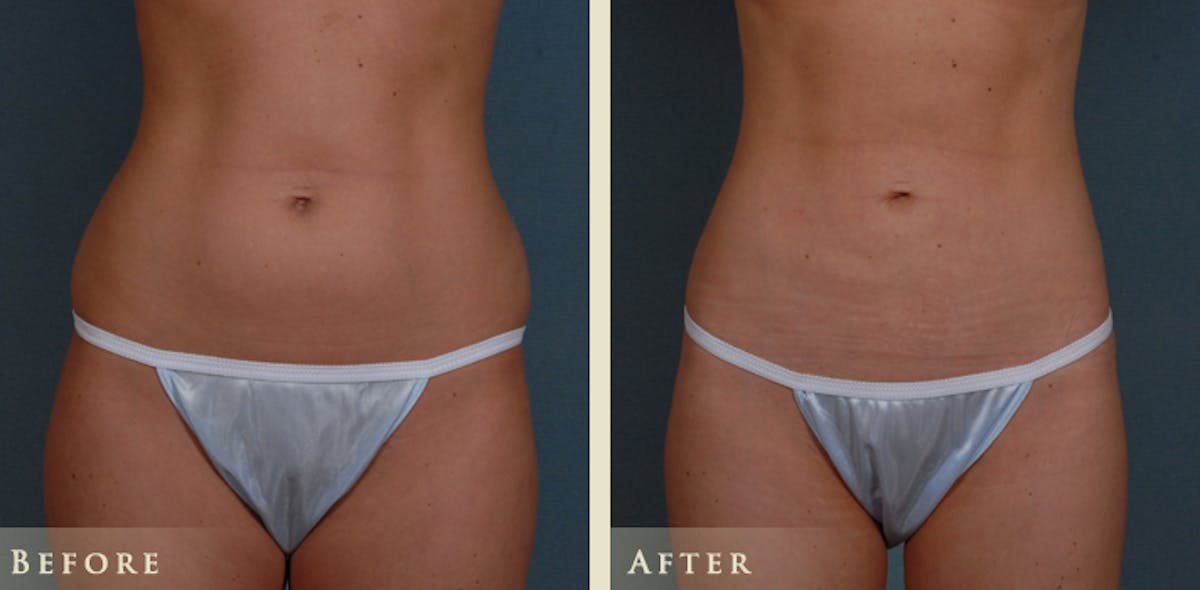 Mommy Makeover Before & After Gallery - Patient 135394 - Image 2