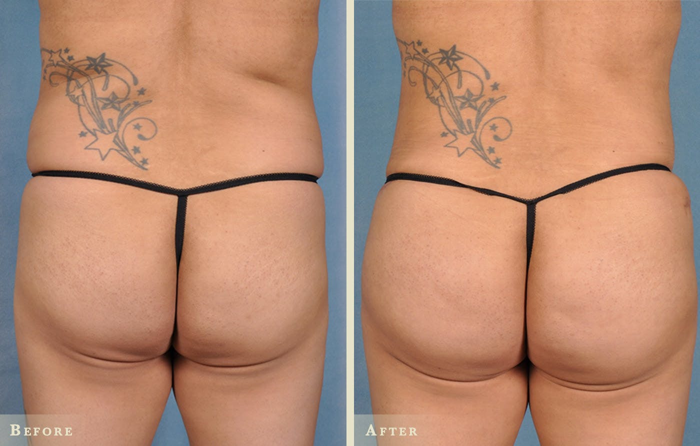 Brazilian Butt Lift Before & After Gallery - Patient 395577 - Image 3