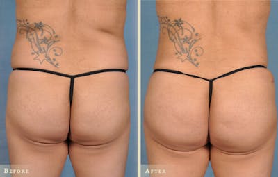 Brazilian Butt Lift Before & After Gallery - Patient 395577 - Image 3