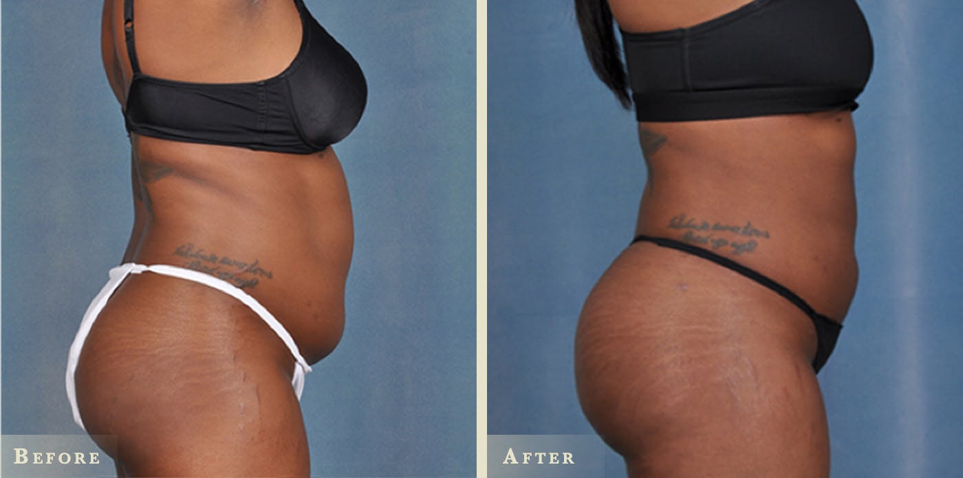 Tummy Tuck Before & After Gallery - Patient 384524 - Image 2