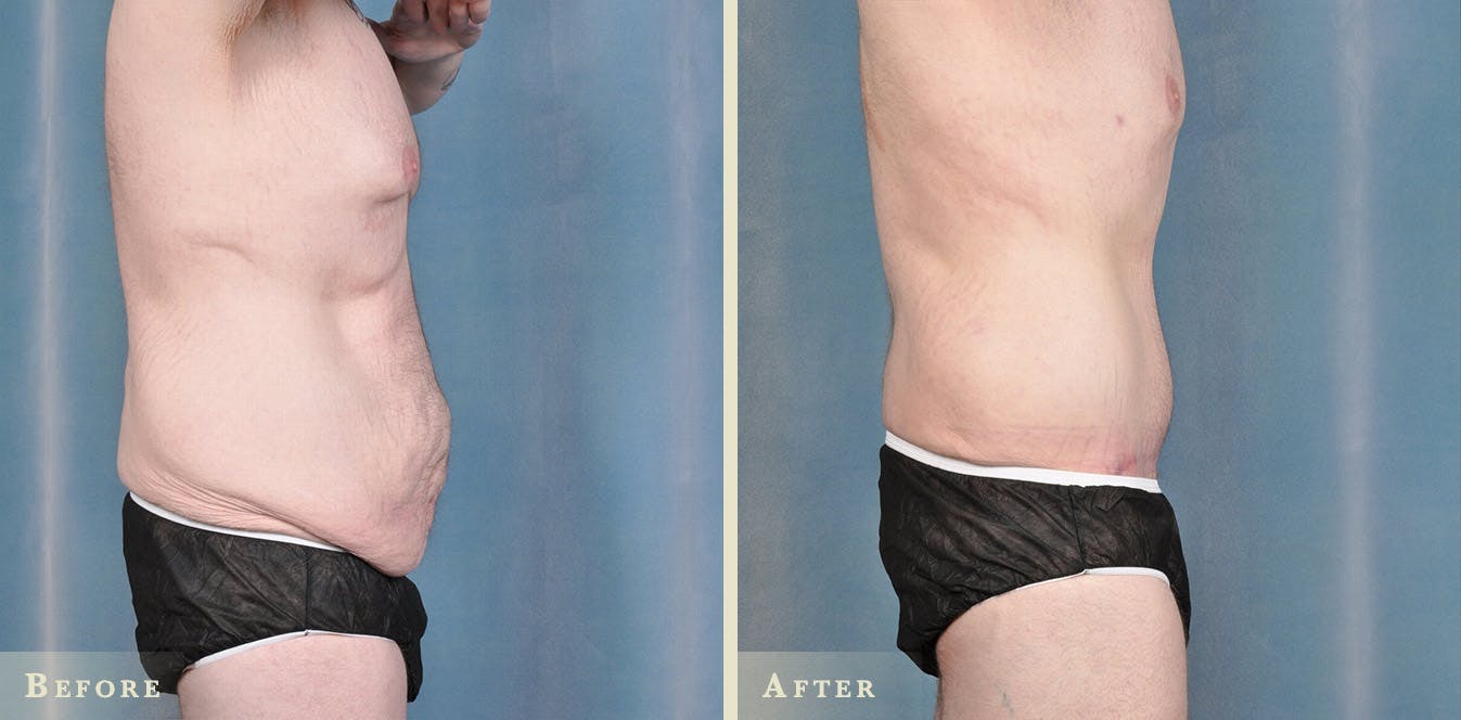 Body Lift Before & After Gallery - Patient 402168 - Image 1