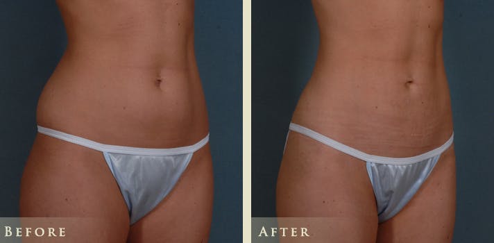 Mommy Makeover Before & After Gallery - Patient 135394 - Image 3