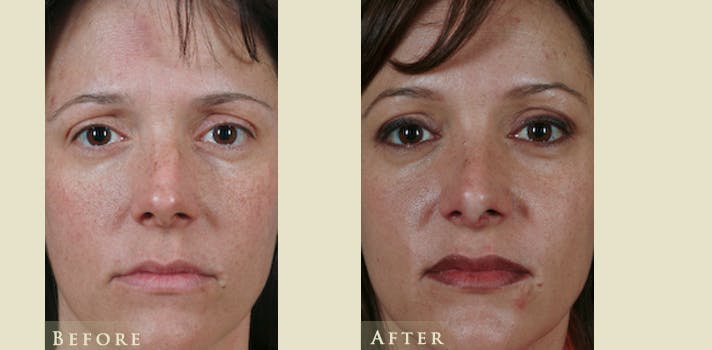 Aesthetic Rhinoplasty Before & After Gallery - Patient 219522 - Image 1