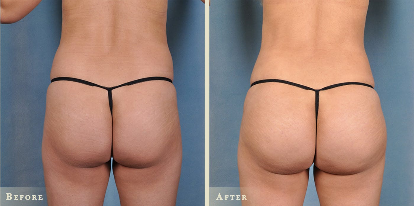 Brazilian Butt Lift Before & After Gallery - Patient 398740 - Image 1