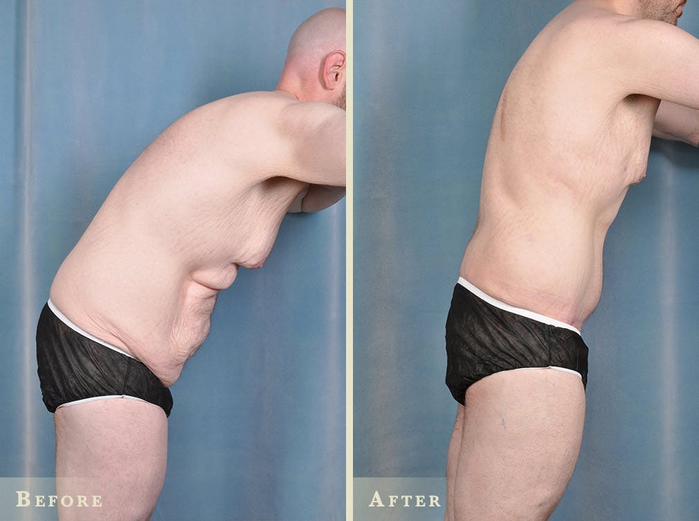 Body Lift Before & After Gallery - Patient 402168 - Image 2