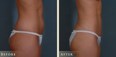 Mommy Makeover Before & After Gallery - Patient 135394 - Image 4