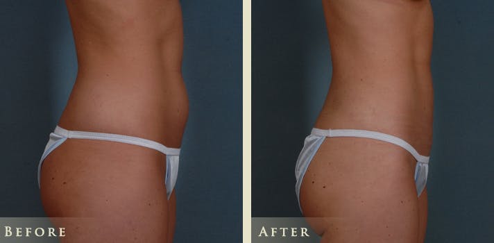 Mommy Makeover Before & After Gallery - Patient 135394 - Image 4