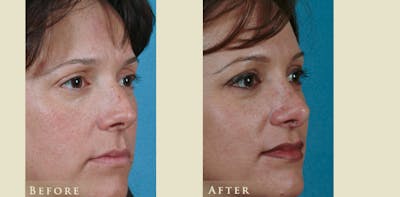 Aesthetic Rhinoplasty Before & After Gallery - Patient 219522 - Image 2