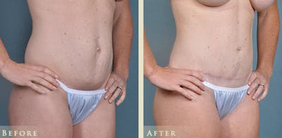 Tummy Tuck Before & After Gallery - Patient 764574 - Image 2