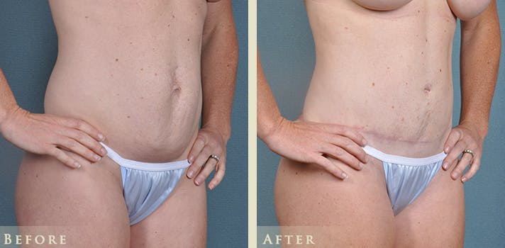 Tummy Tuck Before & After Gallery - Patient 764574 - Image 2