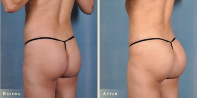 Brazilian Butt Lift Before & After Gallery - Patient 398740 - Image 2