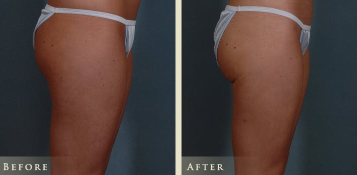 Female Liposuction Before & After Gallery - Patient 282328 - Image 4
