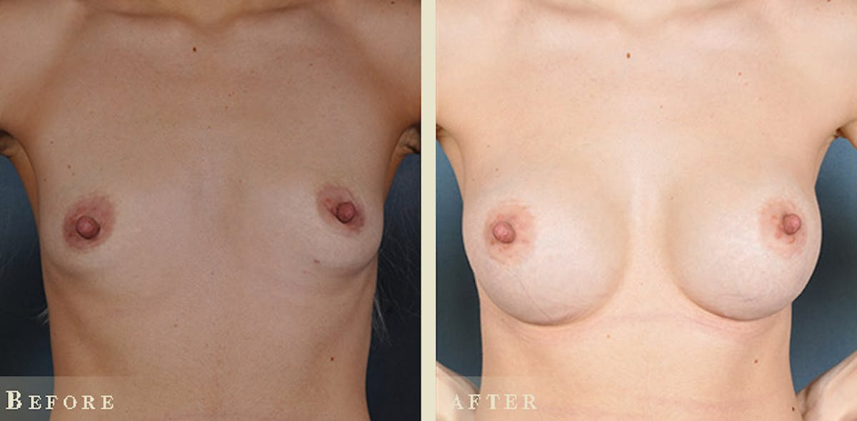 Breast Augmentation with Silicone Implants Before & After Gallery - Patient 130174 - Image 1