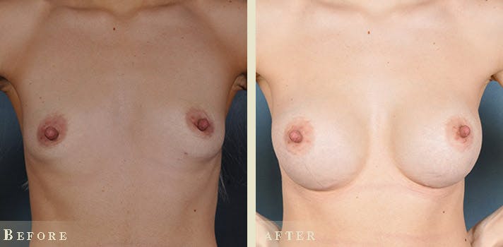 Breast Augmentation Before & After Gallery - Patient 130174 - Image 1