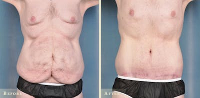 Body Lift Before & After Gallery - Patient 402168 - Image 3