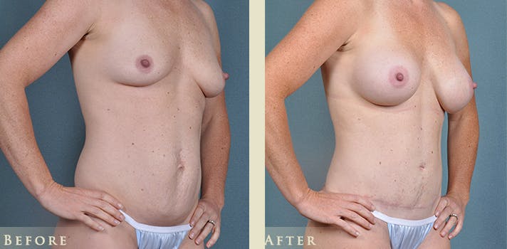 Tummy Tuck Before & After Gallery - Patient 764574 - Image 3