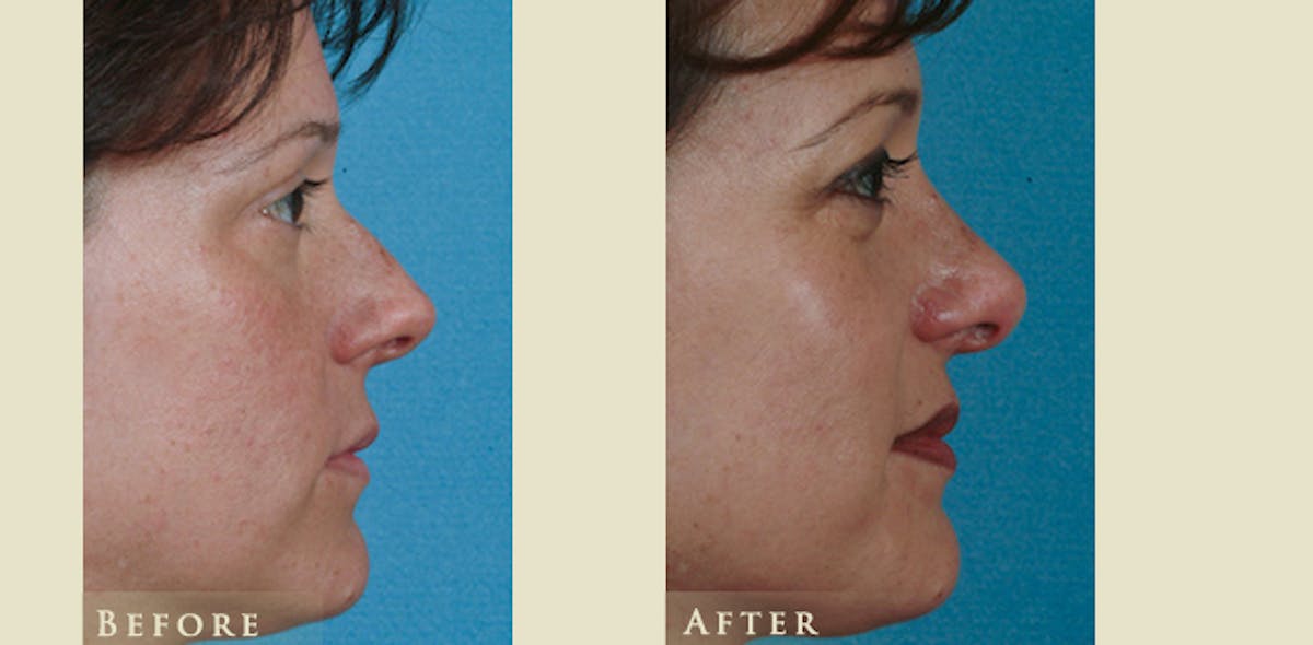 Aesthetic Rhinoplasty Before & After Gallery - Patient 219522 - Image 3