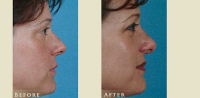 Aesthetic Rhinoplasty Before & After Gallery - Patient 219522 - Image 3