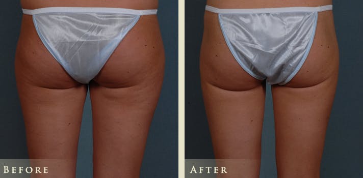 Mommy Makeover Before & After Gallery - Patient 135394 - Image 6