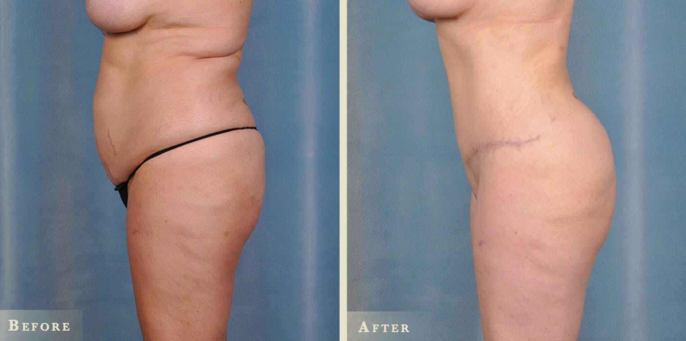 Brazilian Butt Lift Before & After Gallery - Patient 744420 - Image 1