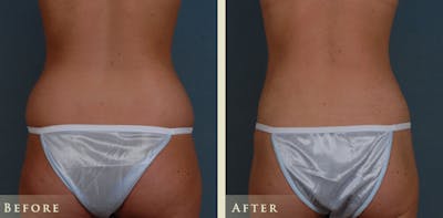 Female Liposuction Before & After Gallery - Patient 282328 - Image 5