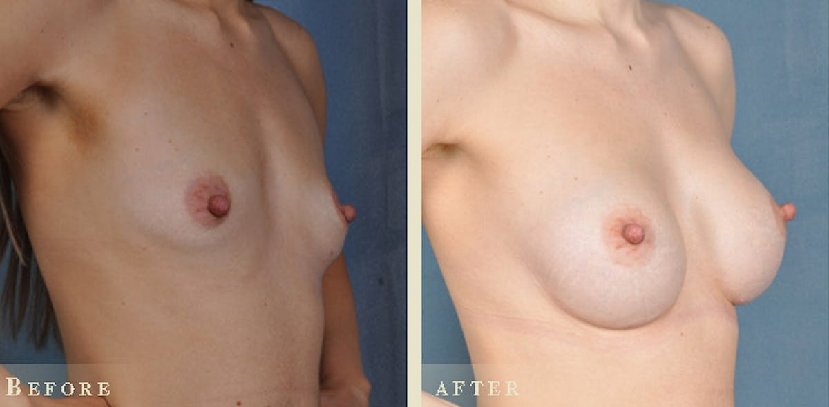 Breast Augmentation with Silicone Implants Before & After Gallery - Patient 130174 - Image 2