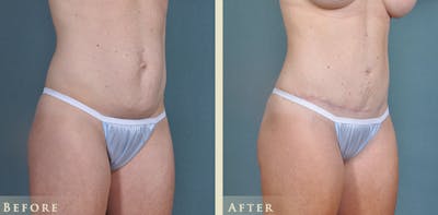 Tummy Tuck Before & After Gallery - Patient 764574 - Image 4