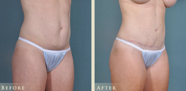 Tummy Tuck Before & After Gallery - Patient 764574 - Image 4