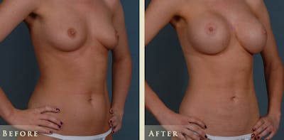 Mommy Makeover Before & After Gallery - Patient 135394 - Image 7