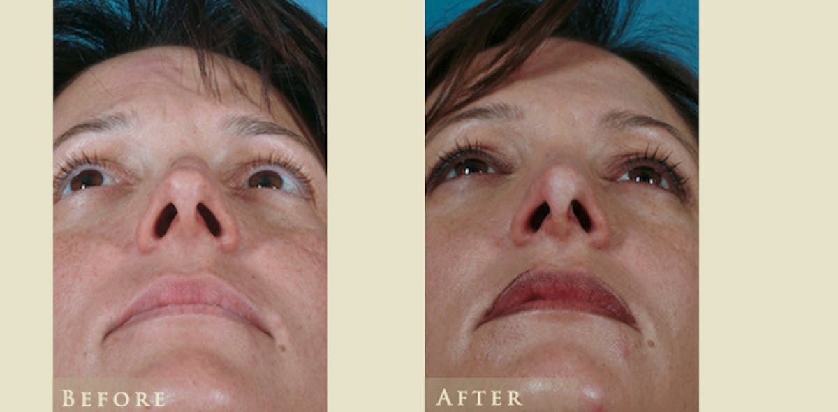 Aesthetic Rhinoplasty Before & After Gallery - Patient 219522 - Image 4