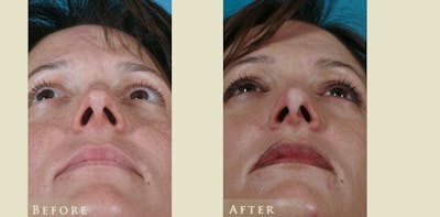 Aesthetic Rhinoplasty Before & After Gallery - Patient 219522 - Image 4