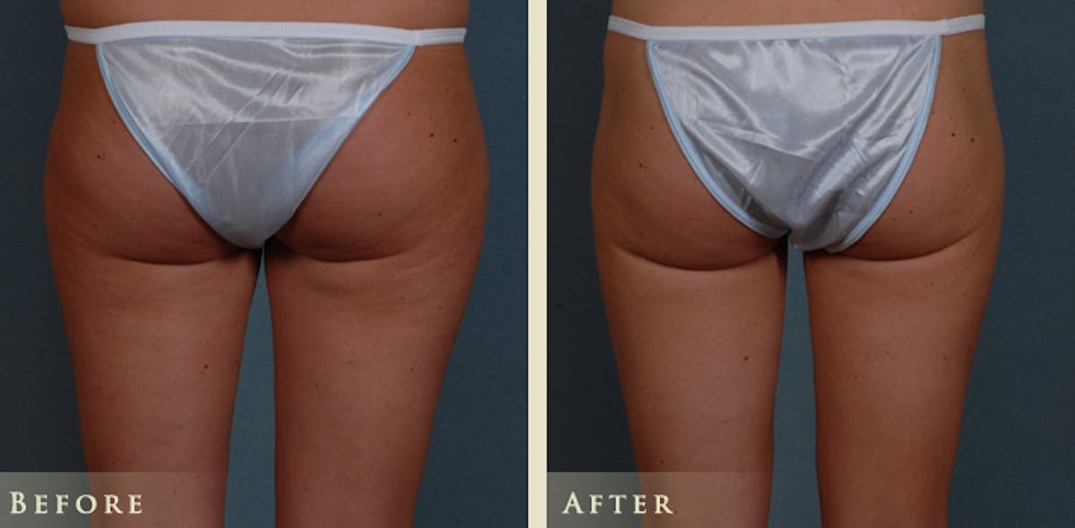 Female Liposuction Before & After Gallery - Patient 282328 - Image 6