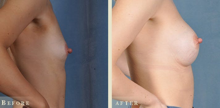 Breast Augmentation Before & After Gallery - Patient 130174 - Image 3