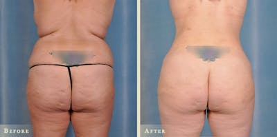 Brazilian Butt Lift Before & After Gallery - Patient 744420 - Image 2