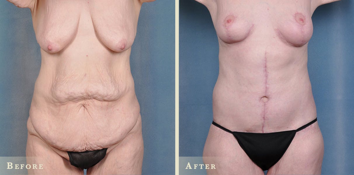 Body Lift Before & After Gallery - Patient 396803 - Image 1