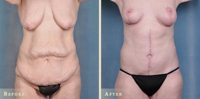 Body Lift Before & After Gallery - Patient 396803 - Image 1