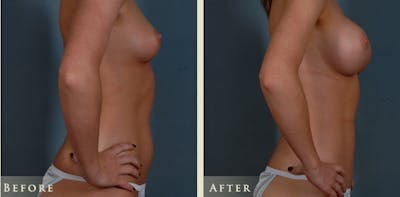 Mommy Makeover Before & After Gallery - Patient 135394 - Image 8