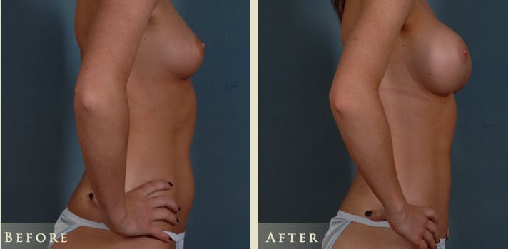 Mommy Makeover Before & After Gallery - Patient 135394 - Image 8