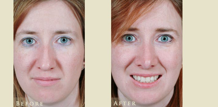 Aesthetic Rhinoplasty Before & After Gallery - Patient 271118 - Image 1