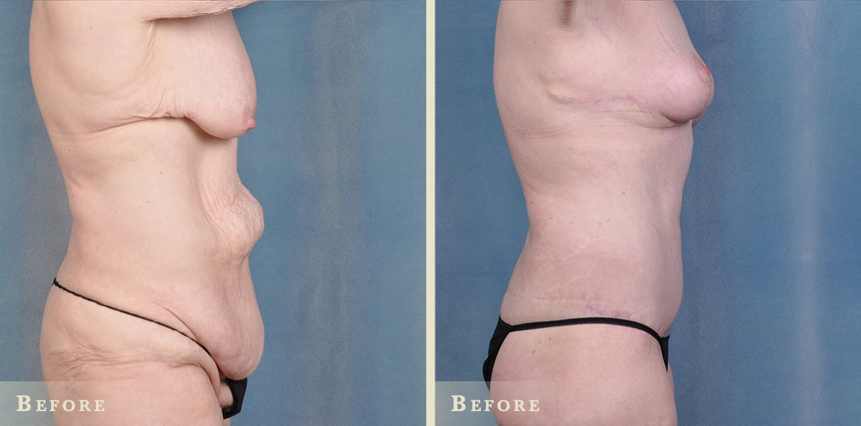 Body Lift Before & After Gallery - Patient 396803 - Image 2