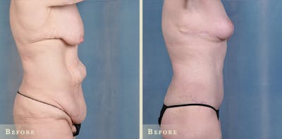 Body Lift Before & After Gallery - Patient 396803 - Image 2