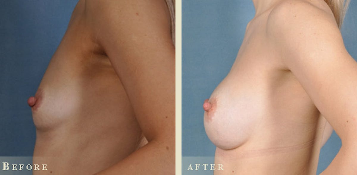 Breast Augmentation with Silicone Implants Before & After Gallery - Patient 130174 - Image 5