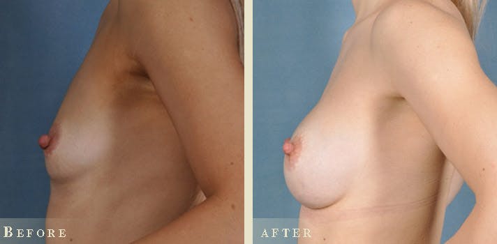 Breast Augmentation Before & After Gallery - Patient 130174 - Image 5